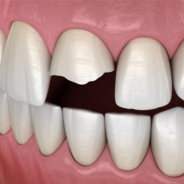 cracked tooth emergency dentist east cobb marietta