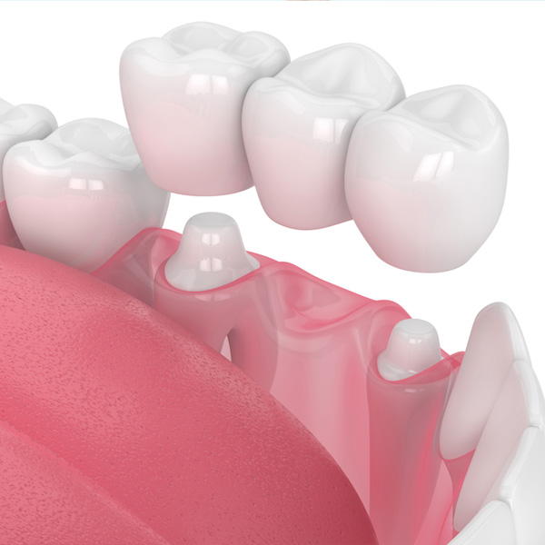 dental-bridge Dental bridge east cobb marietta