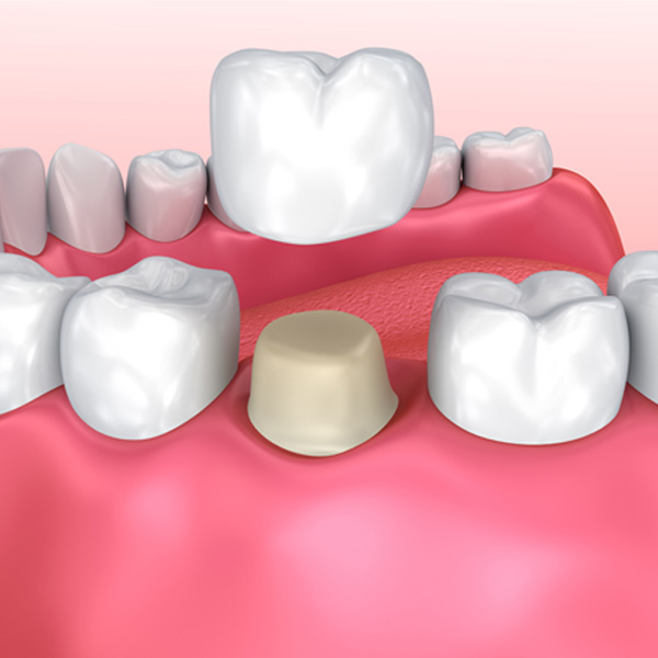 dental crown East Cobb