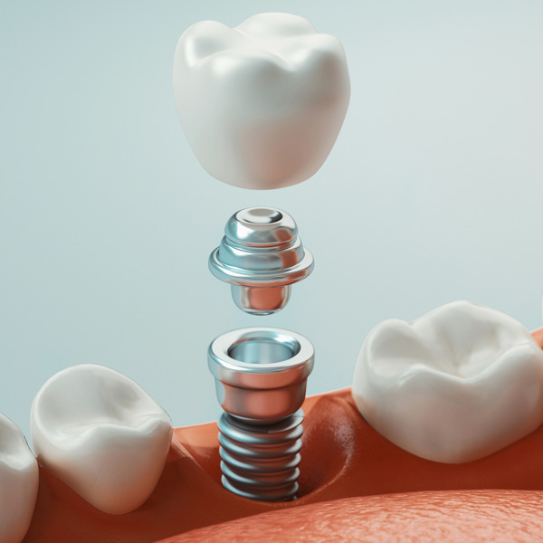 dental implant dentist in east cobb marietta