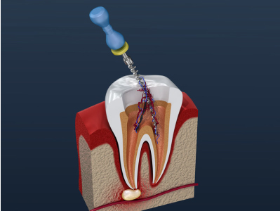 root canal pain east cobb dentist marietta