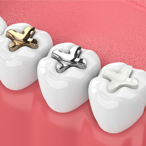 tooth filling to repair decay and cavities in east cobb marietta